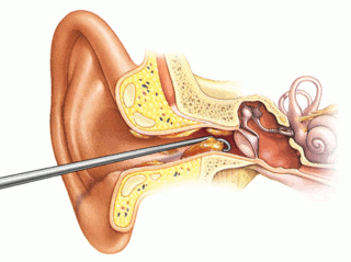 Illustration of the organs of the ear showing a curette removing wax from the ear canal