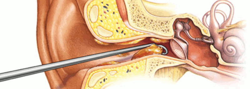 Illustration of the organs of the ear showing a curette removing wax from the ear canal